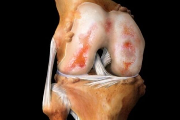 cartilage damage in arthrosis of the knee