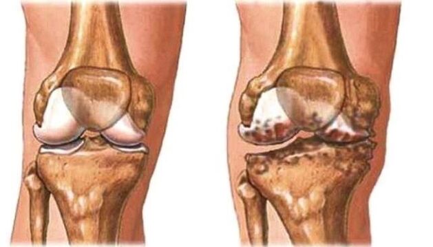 healthy knee and knee arthrosis