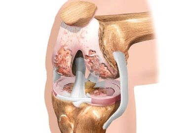 Damage to the knee joint arthrosis