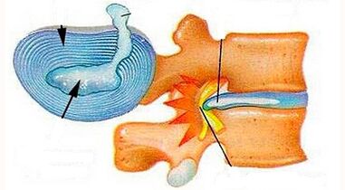 Features of the development of cervical osteochondrosis