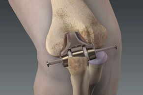 knee replacement for arthrosis